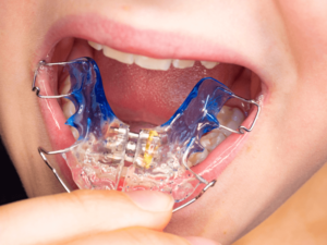 Ortopedia funcional dos maxilares: o que é e como funciona – Blog